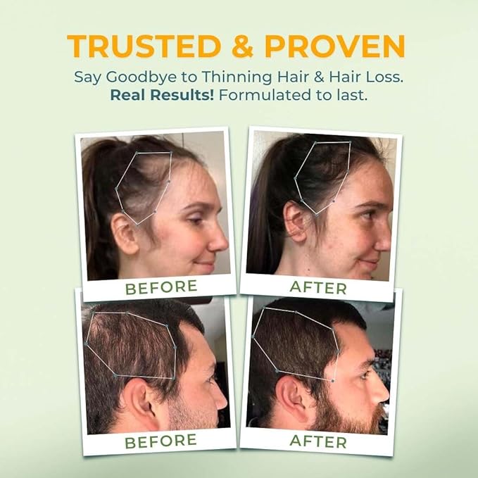 Vital Hair Complex -Hair Growth Vitamins for Women and Men -Biotin &amp Vitamin B -Hair Growth Supplement for Healthy Hair Skin &amp Nails -Hormone &amp Gluten Free -Hair Vitamins for Women