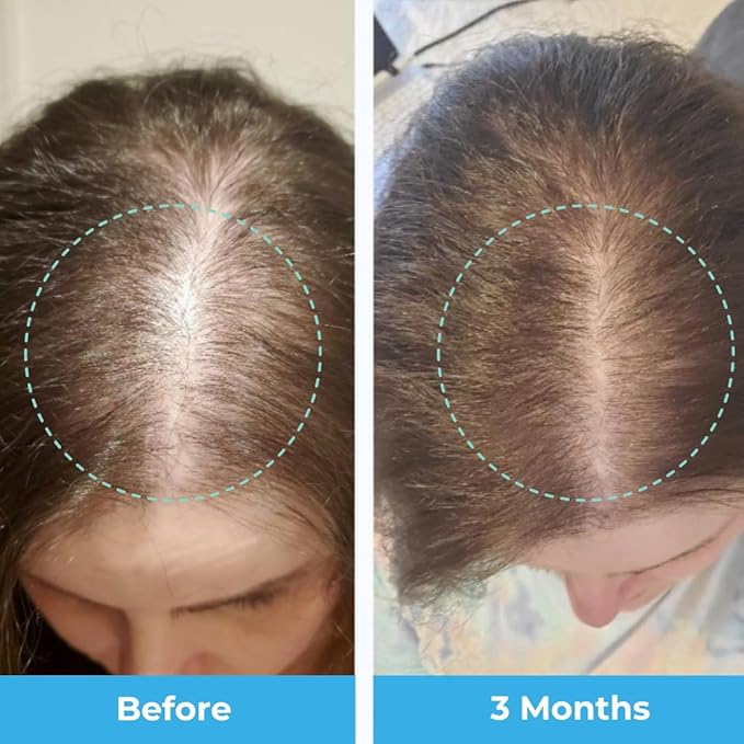 Baby Blues Postpartum Hair Loss Vitamins - Passion Fruit Gummies with Biotin Collagen &amp Folate