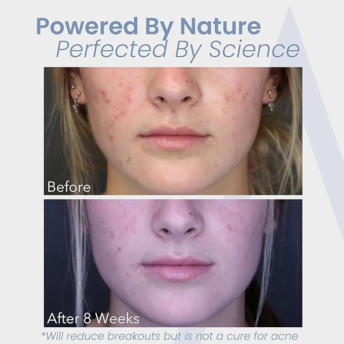 Hormonal Acne Treatment for Women - No DIM - (60 Caps 485 mg) – DIM-Free Acne Medication - Helps Nodular &amp Hormonal Acne - Acne Treatment for Teenagers &amp Adults (60 Count (Pack of 3)