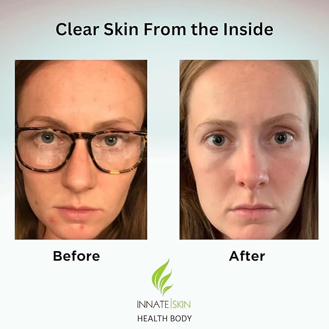 Clear Skin Acne Vitamin System | 20 Antioxidants Botanicals &amp Minerals | 60 Count Pack of 2