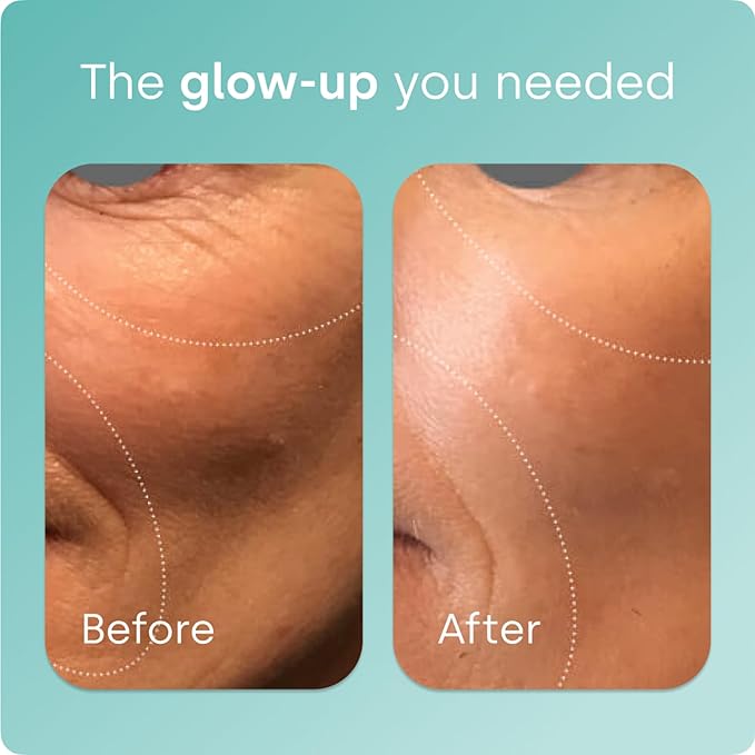 Biosil Collagen Booster Supplement - 180 Original Capsules - Patented ch-OSA Activator for Skin Hair Nails &amp Joints - Supports Natural Production - 90-Day Supply