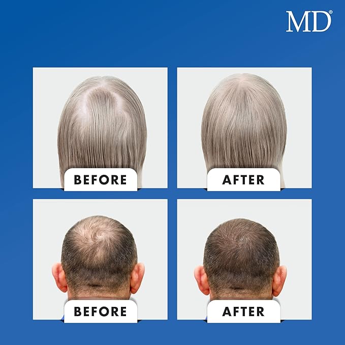 MD Nutri Hair Growth Supplement – Physician Formulated with Lilac Stem Cells Marine Collagen &amp Biotin – Supports Thicker Fuller Hair &amp Reduces Shedding – 30 Drug-Free Vegetable Capsules