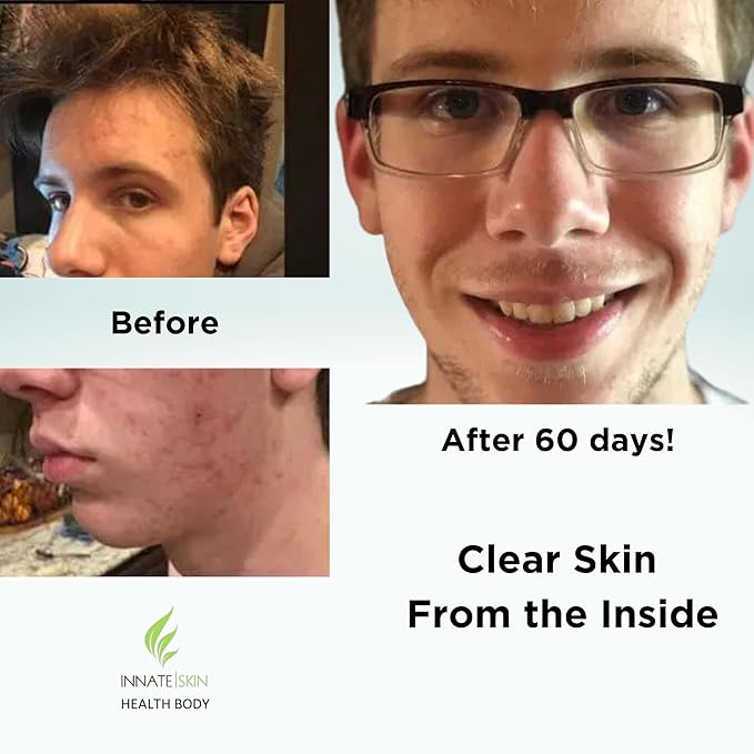 Clear Skin Acne Vitamin System | 20 Antioxidants Botanicals &amp Minerals | 60 Count Pack of 4
