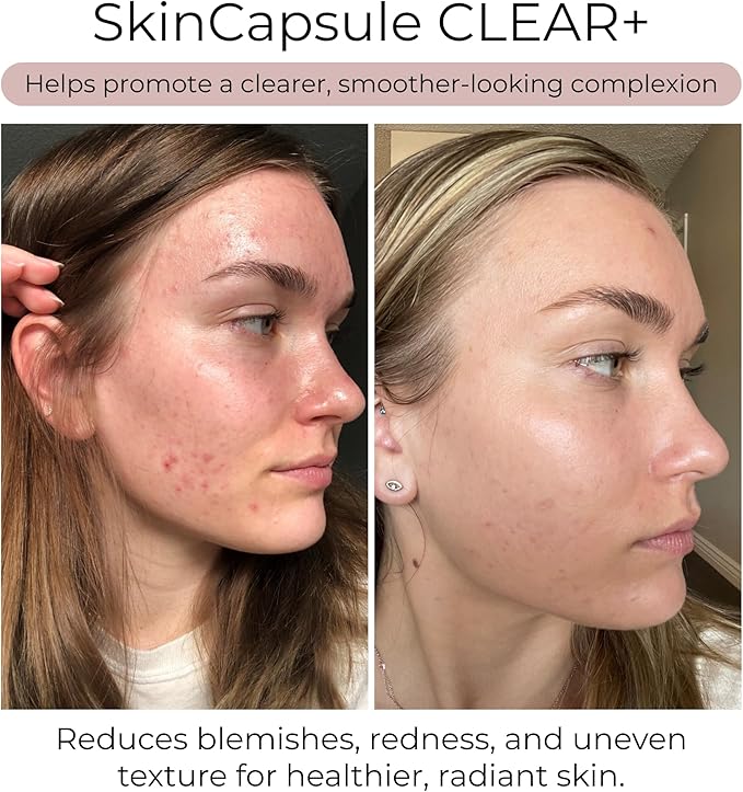 Hush &amp Hush Acne Supplements for Clear Skin – Clinically Proven Formula to Reduce Breakouts &amp Blemishes – Supports Hormonal Balance with Vitamin A Zinc &amp Antioxidants – Vegan Non-GMO – 6