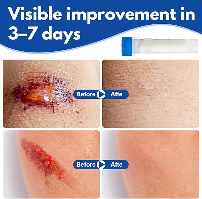 Collagen Powder for Wounds – Medical-Grade Bovine Collagen Collagen Wound Care Powder Supports Tissue Regeneration Accelerates Healing Reduces Scarring 7 Tubes x 1g